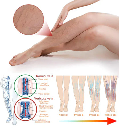 VeinGuard™ - Instant Relief Varicose Vein Patches (Pack of 10)